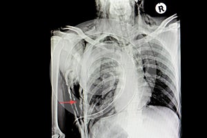 right subcutaneous emphysema and lung contusion