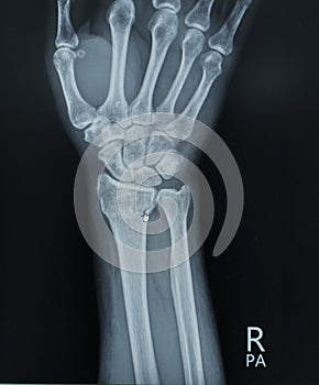 Right Wrist and hand x-ray PA view showing intra-articular comminuted fracture distal radius. Medical image concep