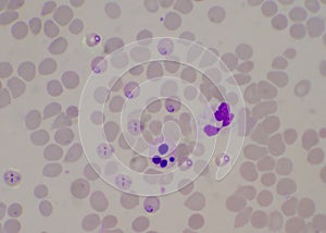 Ring form malaria blood parasite infected red blood cells