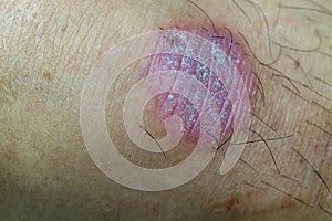 Ring Worm infection, Dermatophytosis on skin. Ringworm infection or Tinea on skin. Mycosis infection on the human skin.