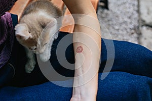 Ringworm on Arm with Hand. Cat disease. Skin problem