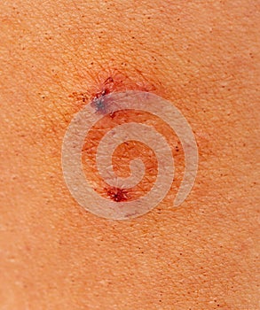 Ringworm on human skin as a background. Macro. photo