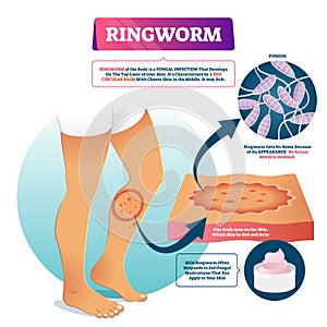 Ringworm vector illustration. Labeled fungal skin infection example scheme. photo