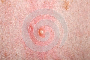 Ripe pimple on the inflamed reddened skin.