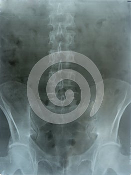 Roentgen of the spine and pelvis