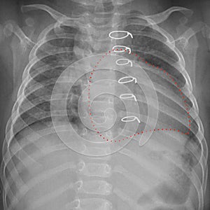 Roentgenogram of the chest in a child after cardiac surgery