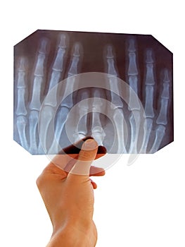 Roentgenogram (X-ray)