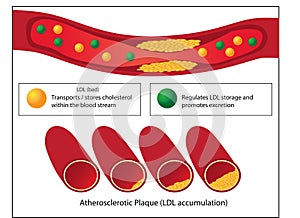 Role of good and bad lipids and levels of atherosclerotic plaque in blood vessel