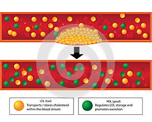 Role of good and bad lipids and levels of atherosclerotic plaque in blood vessel
