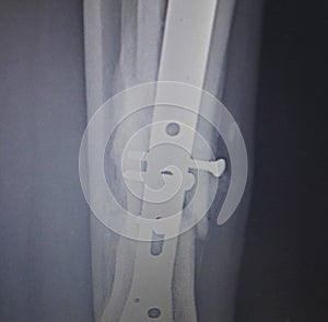 Rontgen of broken leg