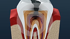 Root canal infection process