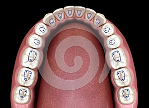 Root canal orifice locations plan of mandible jaw. 3D illustration