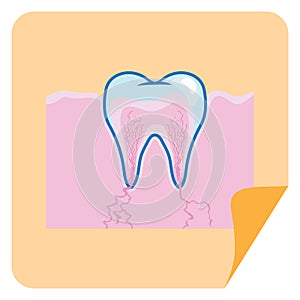 root canal in a tooth. Vector illustration decorative design