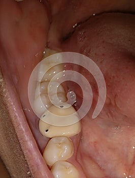 Root canal treated tooth irt 46