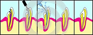 Root Canal Treatment