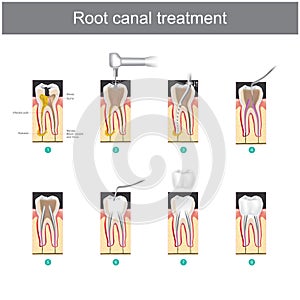 Root canal treatment. How to treat our teeth