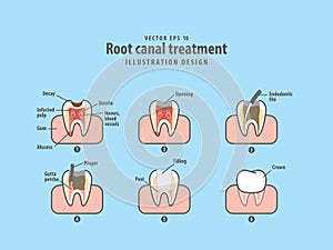 Root canal treatment illustration vector on blue background.