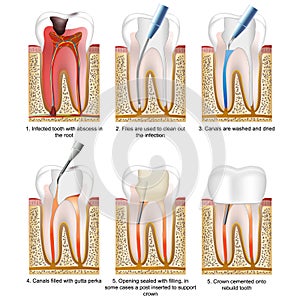 Root canal treatment medical vector illustration isolated on white background with description