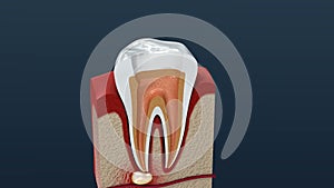 Root canal treatment process.