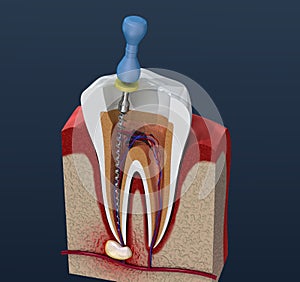 Root canal treatment process. illustration photo