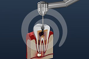 Root canal treatment process. illustration