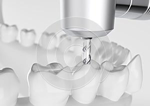 Root treatment with a drill closeup - 3D Rendering