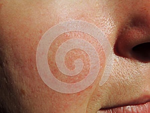 Rosacea on face of middle aged woman