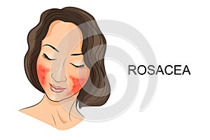 Rosacea on the girls face. Dermatology