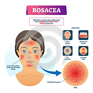 Rosacea vector illustration. Labeled red skin problem explanation scheme.