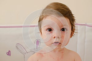 Roseola infantum