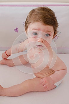 Roseola infantum