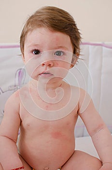 Roseola infantum