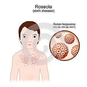 Roseola. sixth disease. infectious disease. human herpes viruses