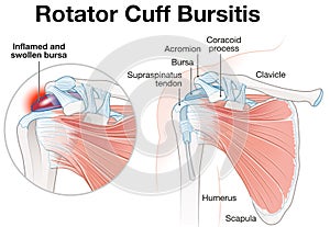 Rotator Cuff Bursitis Shoulder Illustration. Labeled
