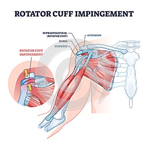 Rotator cuff impingement and anatomical shoulder muscle outline diagram