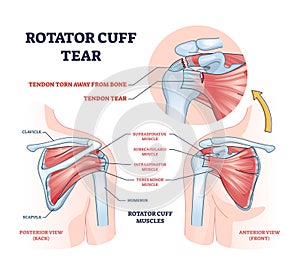 Rotator cuff tear as shoulder muscle trauma or arm injury outline diagram