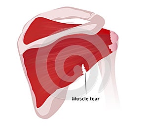 Rotator cuff tear. Illustration of the rotator cuff muscle anatomy