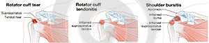 Rotator cuff tear, rotator cuff tendonitis, shoulder bursitis photo