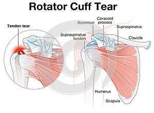 Rotator Cuff Tear Shoulder Illustration. Labeled