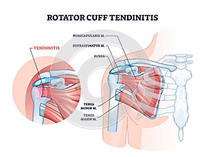 Rotator cuff tendinitis as shoulder muscular inflammation outline diagram photo