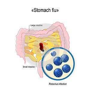 Rotavirus infection or stomach flu. Small intestine and colon