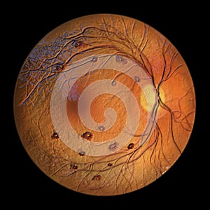 Roth spots in the retina, 3D illustration