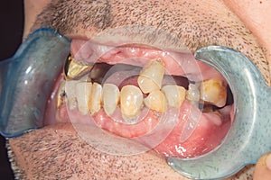 Rotten teeth, caries and plaque close-up in an asocially ill patient. The concept of poor hygiene and health problems photo