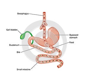 Roux-en-Y gastric bypass operation