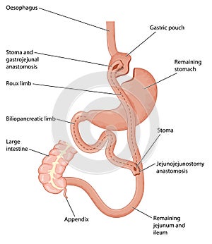 Roux-en-Y gastric bypass surgery