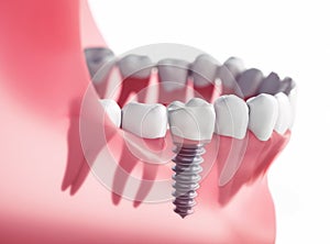 Closeup of dental implant in jaw photo