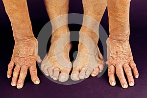 Rrheumatoid arthritis hand and toe deformities