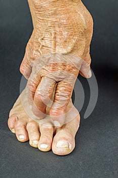 Rrheumatoid arthritis hand and toe deformities