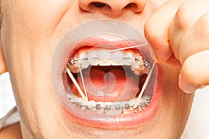 Rubber strings for teeth correction with braces photo