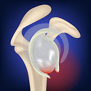 rupture of the clavicular cavity. Rendering of a collarbone on a blue neon background